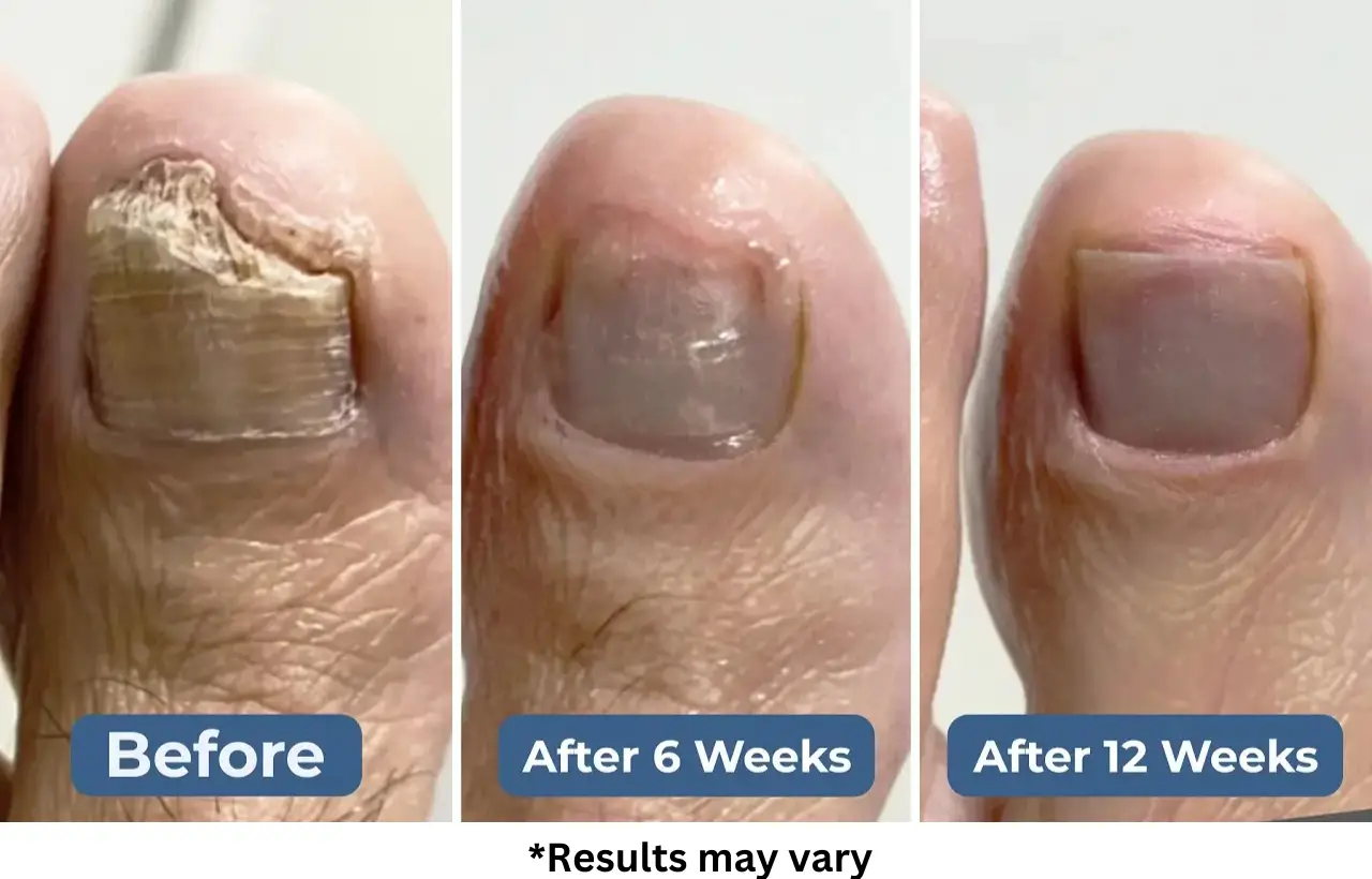 Case #2: A 62-Year-Old Woman Canceled Surgery and Wiped Out Fungus in 5 Weeks